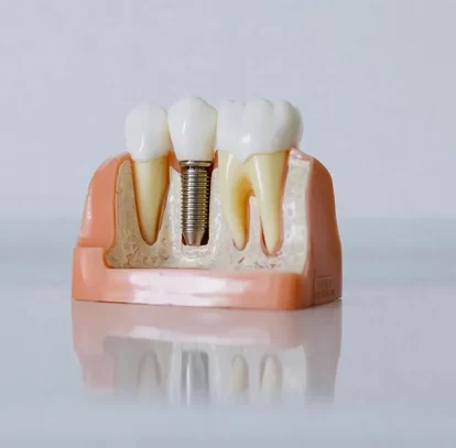 Missing Teeth? Exploring Dental Implant Options in Summerland